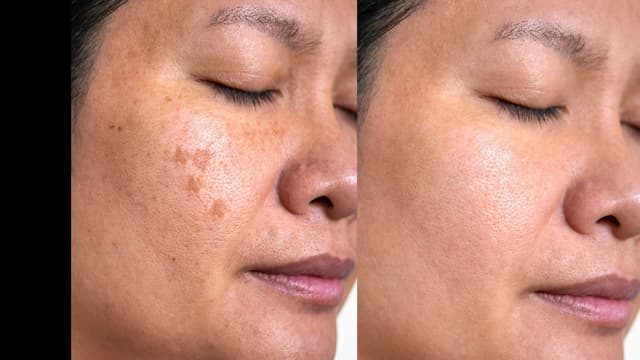 <span class="" word="レ">レ</span><span class="" word="ー">ー</span><span class="" word="ザ">ザ</span><span class="" word="ー">ー</span><span class="" word="で">で</span><ruby ><rb><span class="jlpt-n3" word="肌">肌</span></rb><rt>はだ</rt></ruby><span class="" word="を">を</span><span class="jlpt-n5" word="きれい">きれい</span><span class="" word="に">に</span><span class="" word="す">す</span><span class="" word="る">る</span>