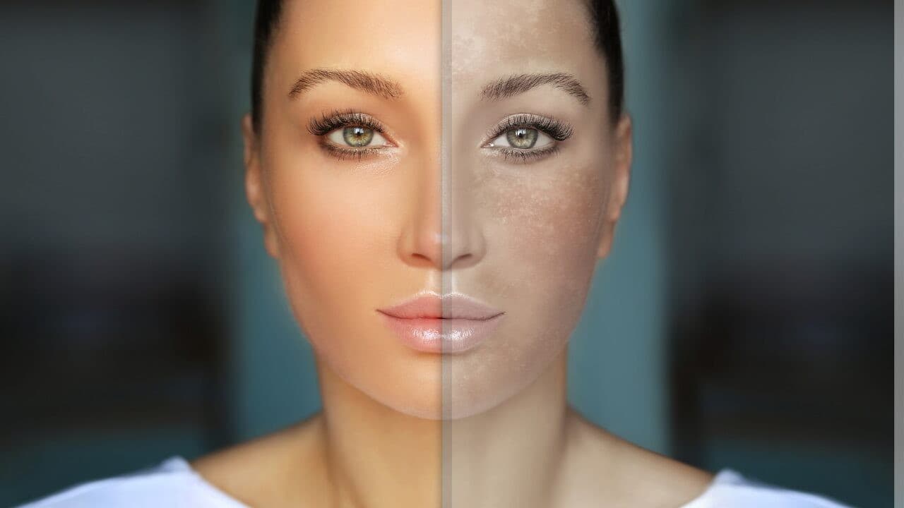 そばかすをふやさないやさしい方法