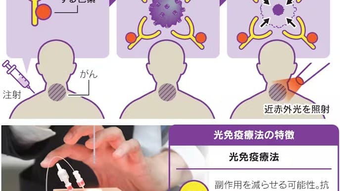 光免疫療法によるがん治療の進展とその臨床的意義