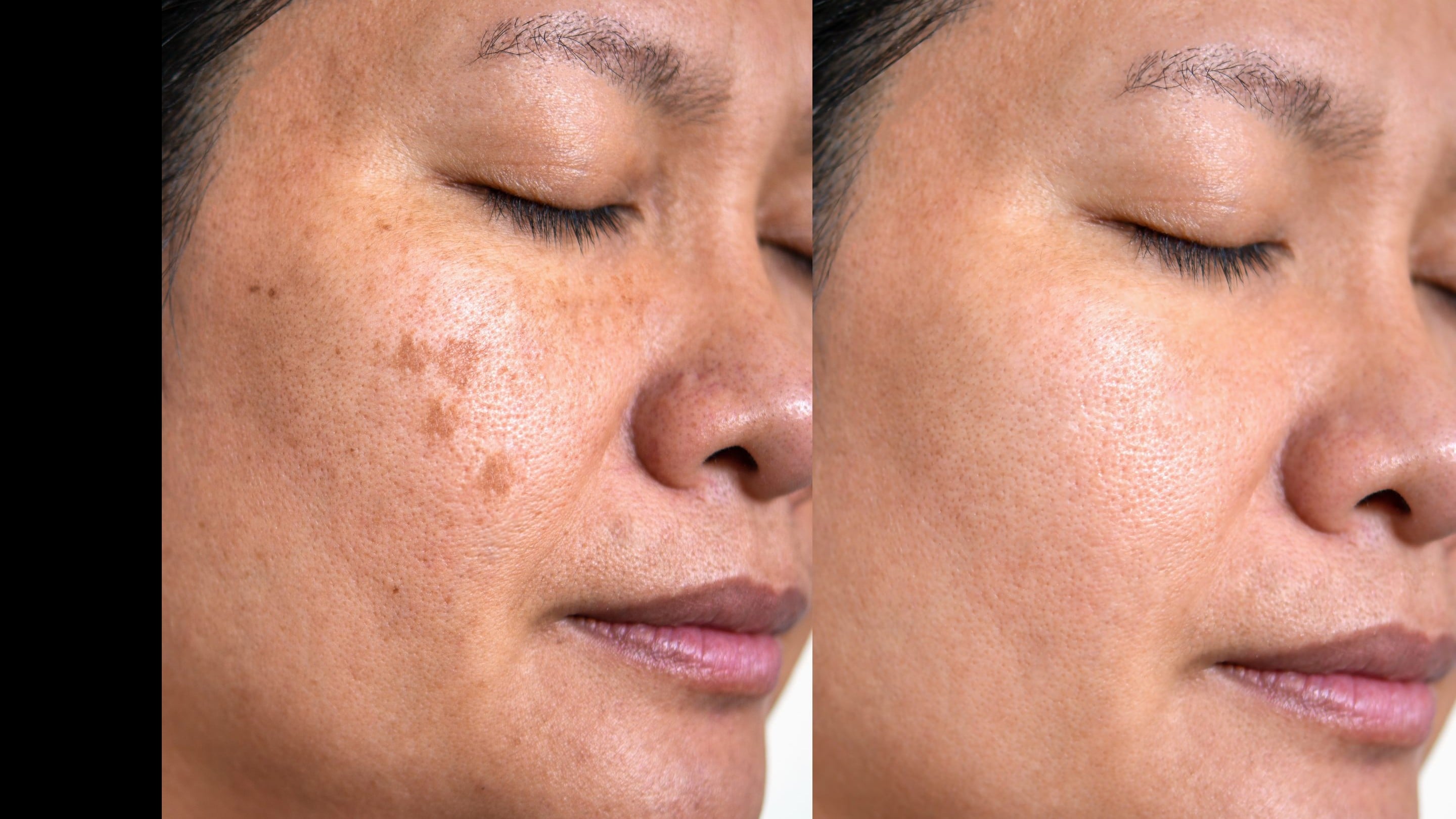 レーザーで肌をきれいにする