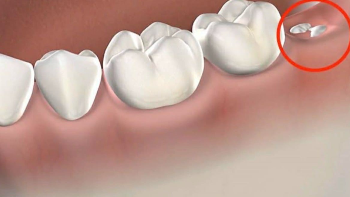 大阪の病院、AIで親知らずの抜歯をサポート